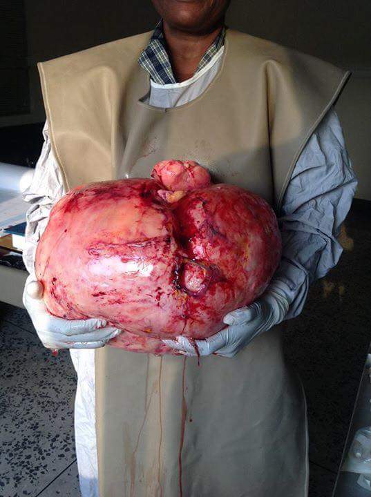 Safe Hands Medicare Amuwo Carries Out Major Fibroid Operation (2)